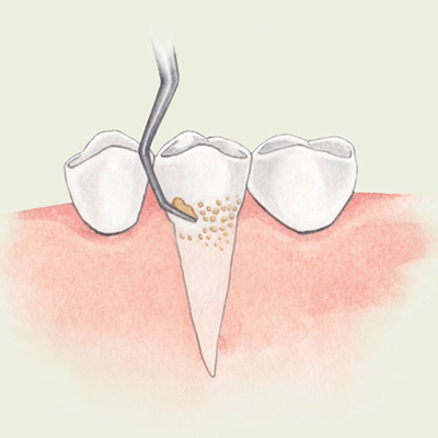 치근활택술